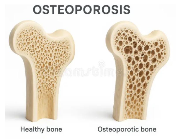 osteo